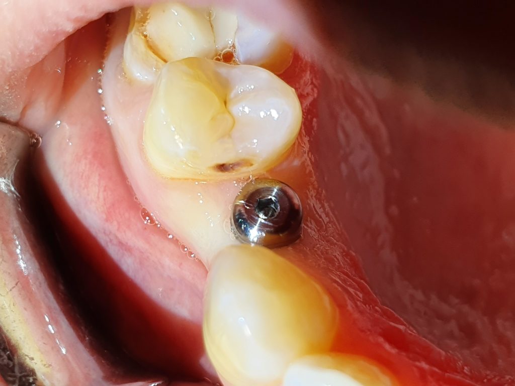 Implant dentaire : quand est-ce qu’il faut l’utiliser ?